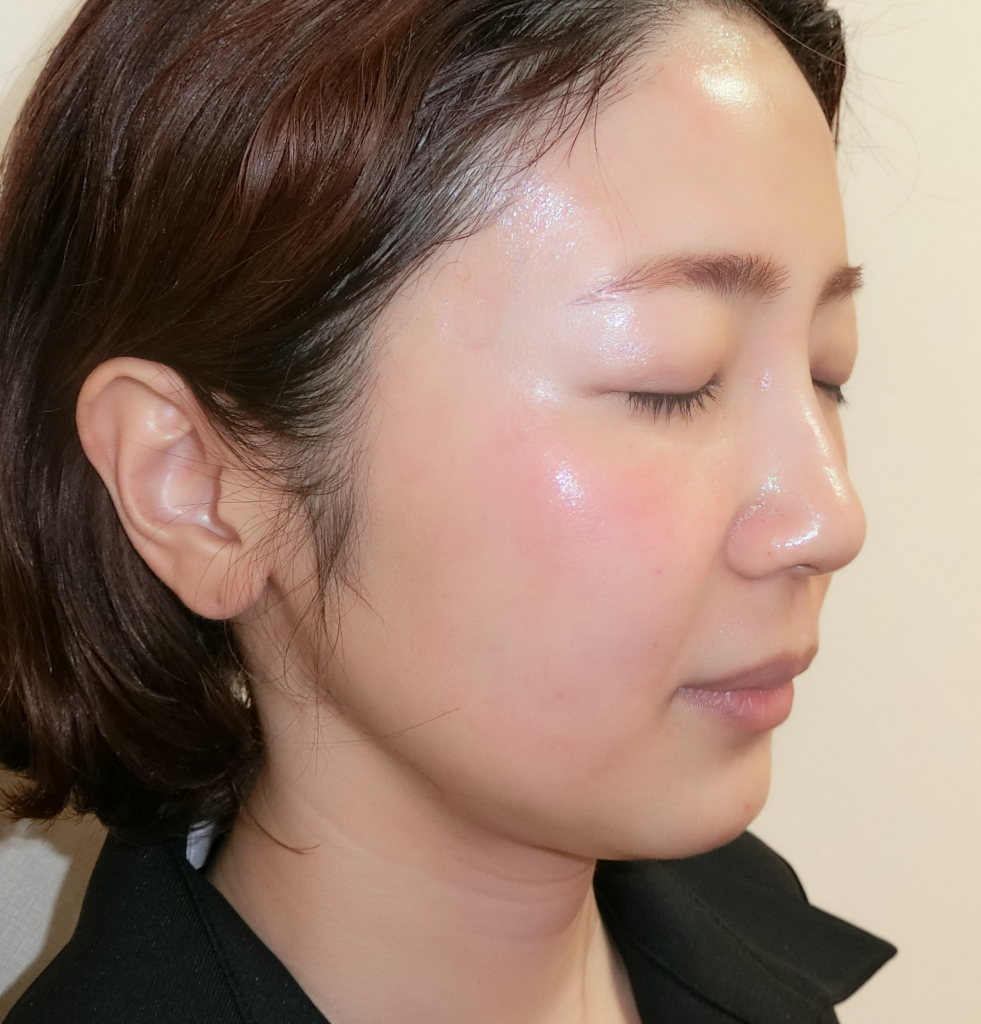 ライムライト やさしい美容皮膚科 皮フ科 秋葉原院 コラム レーザー治療 アトピー性皮膚炎