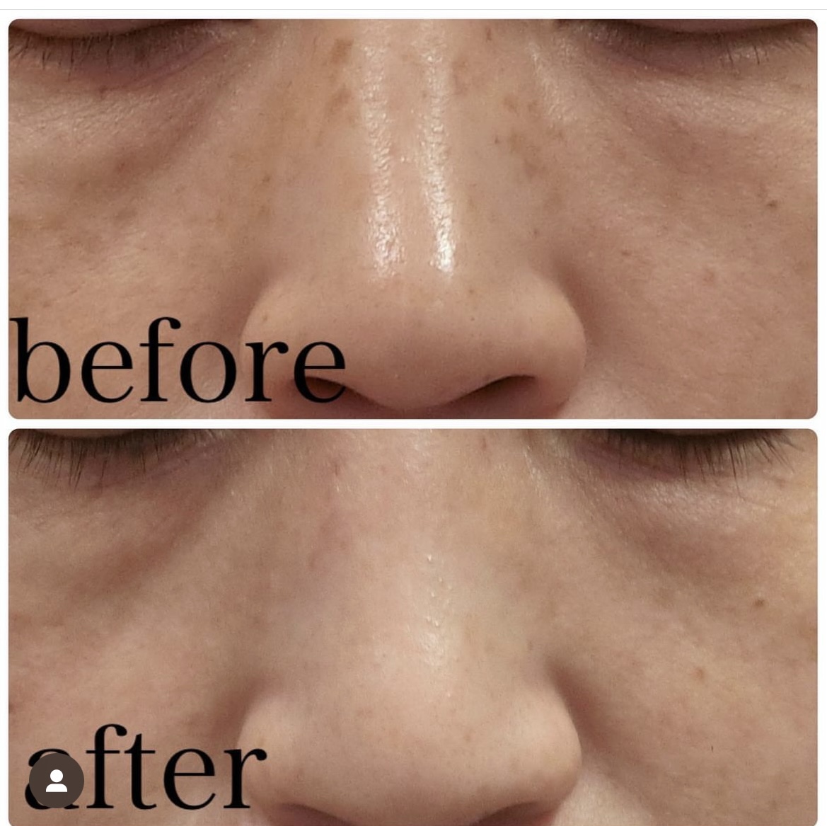 そばかす そばかす・しみ 撃退！ | やさしい美容皮膚科・皮フ科 秋葉原院 コラム