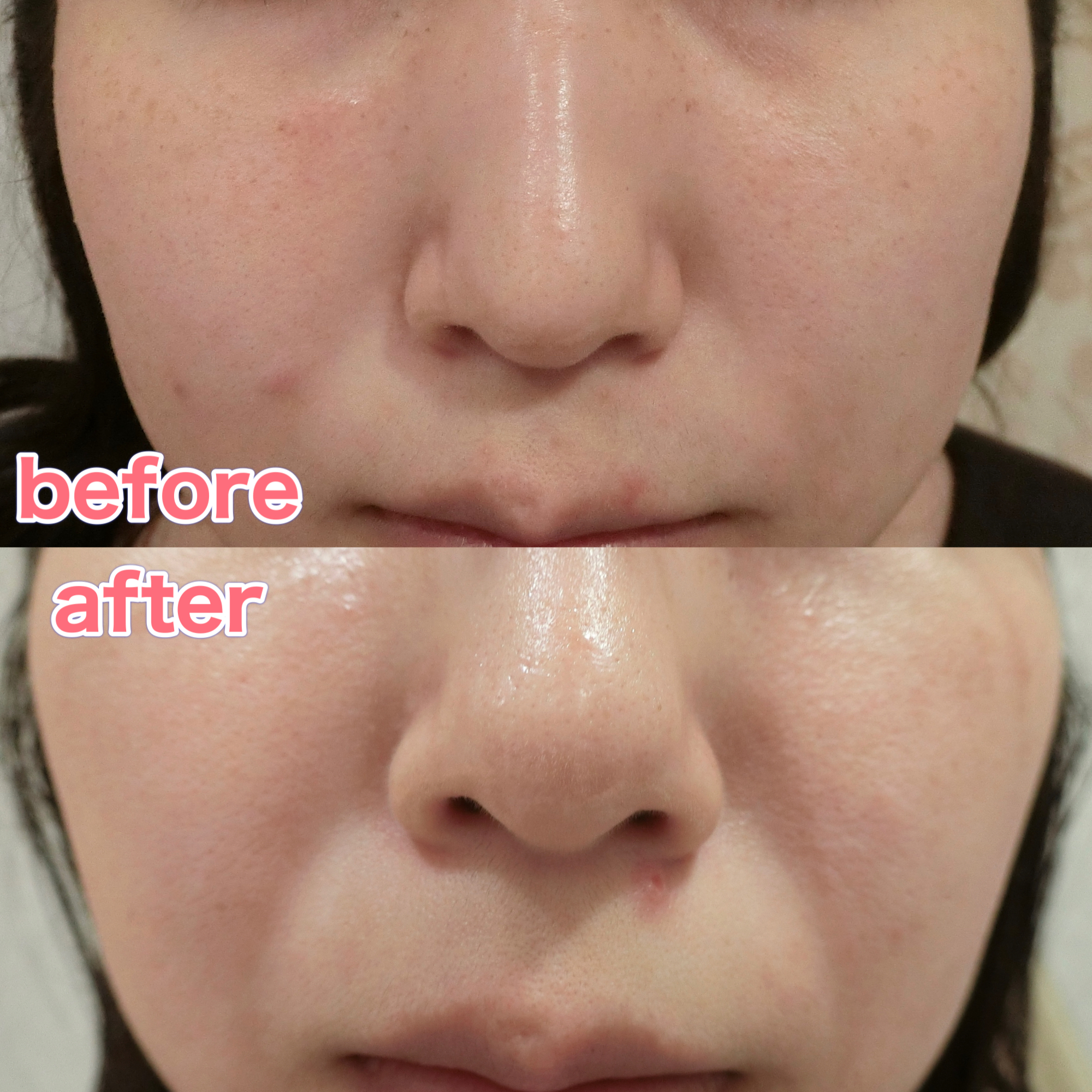 ピーリングの効果について | やさしい美容皮膚科・皮フ科 秋葉原院  