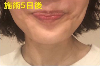 あごボトックス